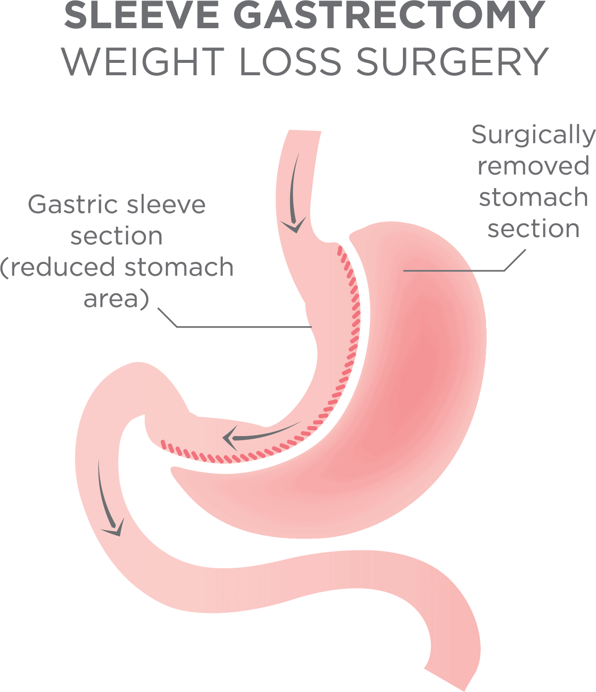 Vitamins For Bariatric Surgery